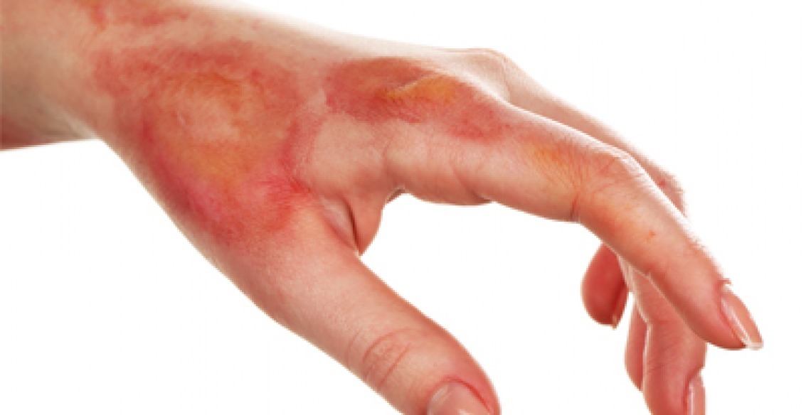 Ustioni quali sono i lavoratori particolarmente a rischio?